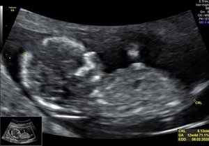Nuchal Translucency Scan - CRL