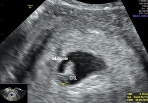 Early Pregnancy Scan- CRL