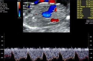 Nuchal Translucency Scan- ductus venosus Dopplers