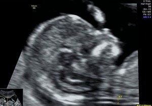 Nuchal Translucency Scan - NT