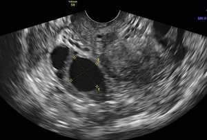 Follicular Study- ovarian follicles- day 15