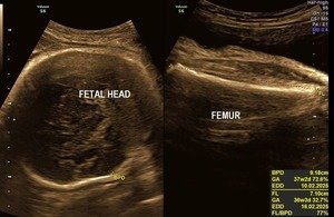 Growth Scan- fetal head & femur