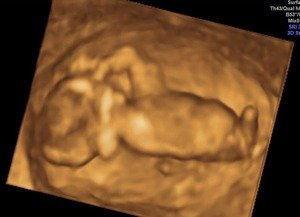 3D & 4D Pregnancy Scan- 3D scan 12 weeks