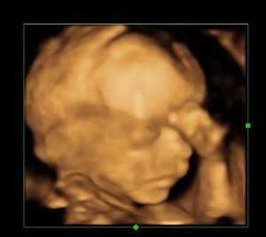 3D & 4D Pregnancy Scan- 3D face