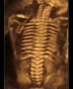 3D & 4D Pregnancy Scan- 3D spine