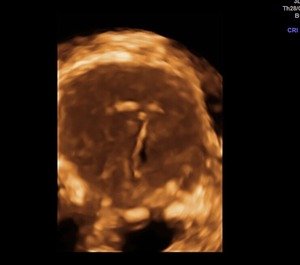 3D Pelvic Scan- Mirena
