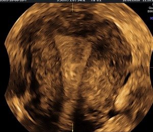 3D Pelvic Scan -uterus