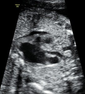 fetal 2D ECHO - abnormal fetal heart