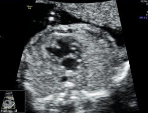 fetal 2D ECHO- abnormal fetal heart