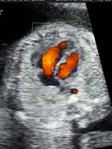fetal 2D ECHO- blood flow