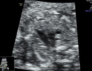 fetal 2D ECHO- 3VT view