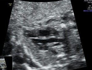 fetal 2D ECHO- normal LVOT