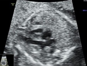 fetal 2D ECHO- normal fetal heart